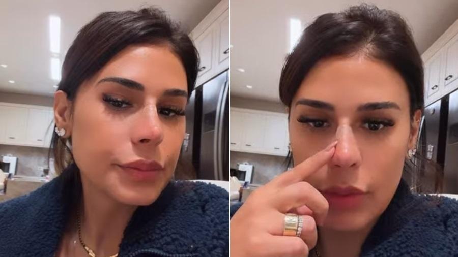 Imagem ilustrativa sobre Simone Mendes nega rinoplastia e explica que “amarrou com fios